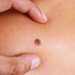 Metastatic Melanoma: Symptoms, Stages, Treatment