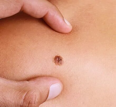 Metastatic Melanoma: Symptoms, Stages, Treatment